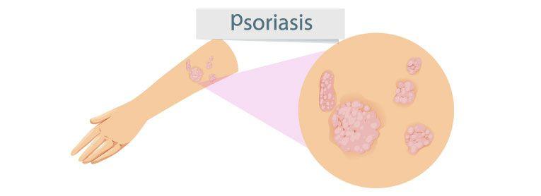 ¿Qué es la psoriasis?