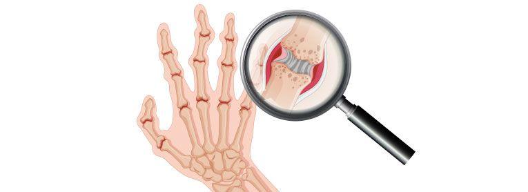 Día mundial de la osteoporosis